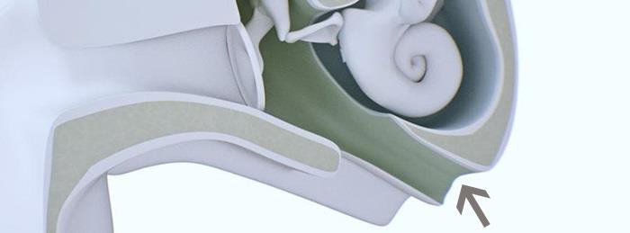 The Eustachian tube.